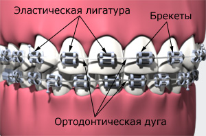 Несъемный ортодонтический аппарат, брекеты, DENTEX