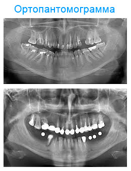 Ортопантомограмма, стоматология «Дентекс» Новокузнецк
